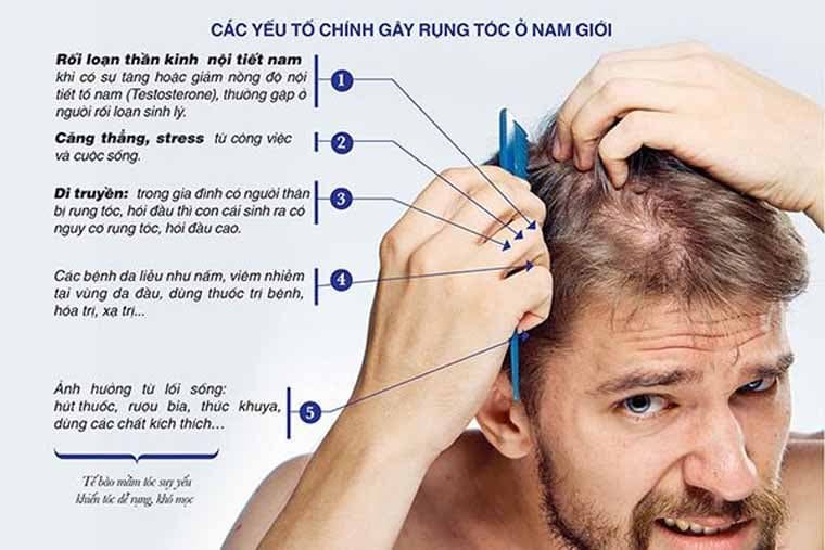 Các yếu tố chính gây rụng tóc ở nam giới